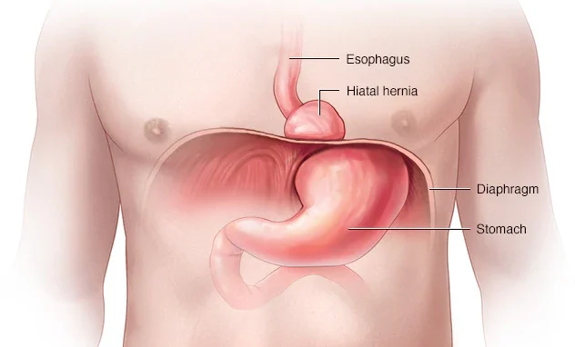 Hernia hiatal