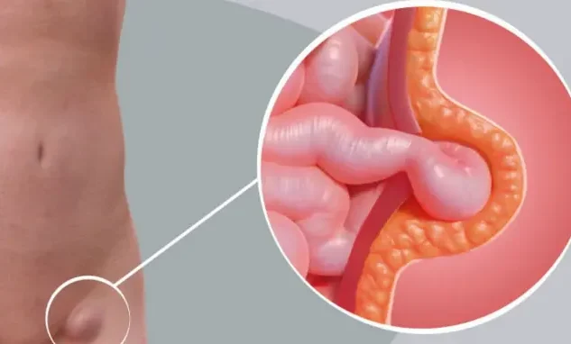 Hernia de la pared abdominal